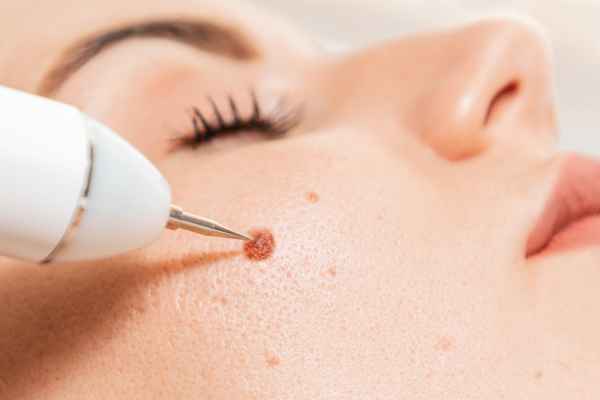 CryoPen: 5 Skin Concerns It May Be Used to Treat 3 What actually happens during a CryoPen treatment Dunchurch?