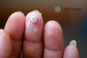 Cryopen Top 5 Treatable Conditions 4 Do you have a persistent wart of verruca that you cannot shit? Cryopen Dunchurch treatment will work call us NOW!