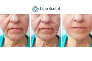 Explaining Morpheus8 And What It Can Do For You 3 Boost your confidence with Morpheus8 Dunchurch call our team today!