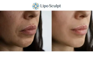 Explaining Morpheus8 And What It Can Do For You 4 Morpheus8 Dunchurch the best results - call our team today!