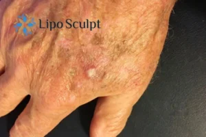 Best Actinic Keratoses Removal 2 Improve your wellbeing and health with Actinic Keratoses Dunchurch removal.treatment