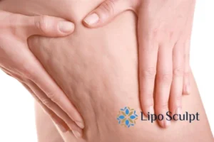 CoolSculpting for Legs: The Innovative Approach to Redefining Your Legs 5 Start your journey today book your coolsculpting treatment Dunchurch online today!