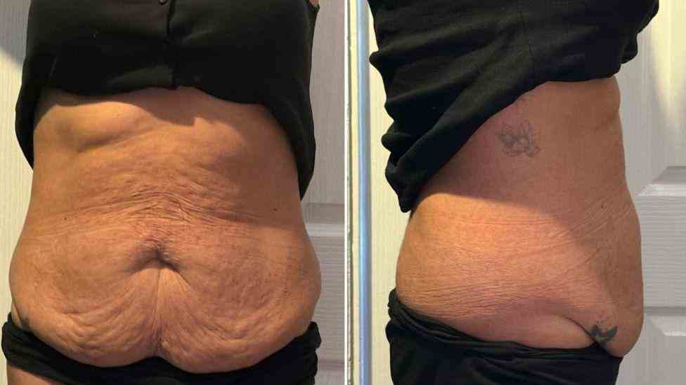 Lost the Weight but Not the Loose Skin? What You Should Know 1 Is It Definitely Loose Skin Dunchurch?