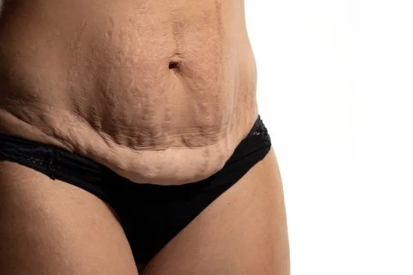 Lost the Weight but Not the Loose Skin? 1 image of womans stomach after weight loss showing loose skin Dunchurch